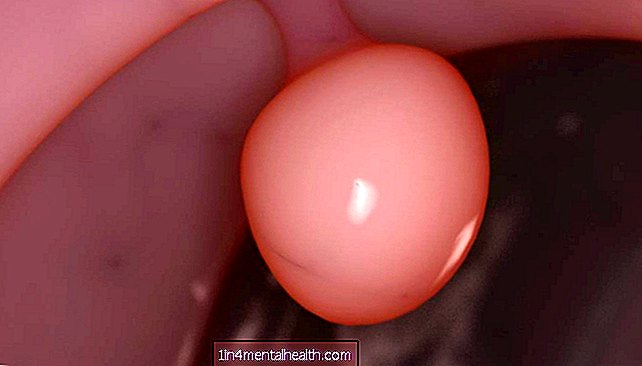 Hva er symptomene på en polypp i livmorhalsen? - fruktbarhet