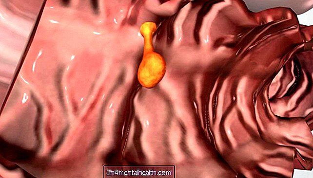 Kas jāzina par resnās zarnas polipiem - kuņģa-zarnu trakta - gastroenteroloģija