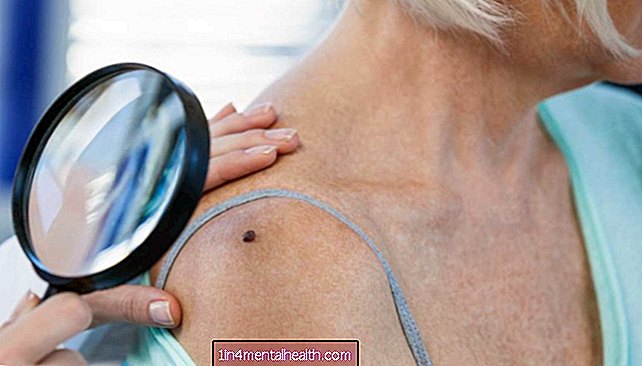 Jauns savienojums varētu cīnīties pret agresīvu melanomu