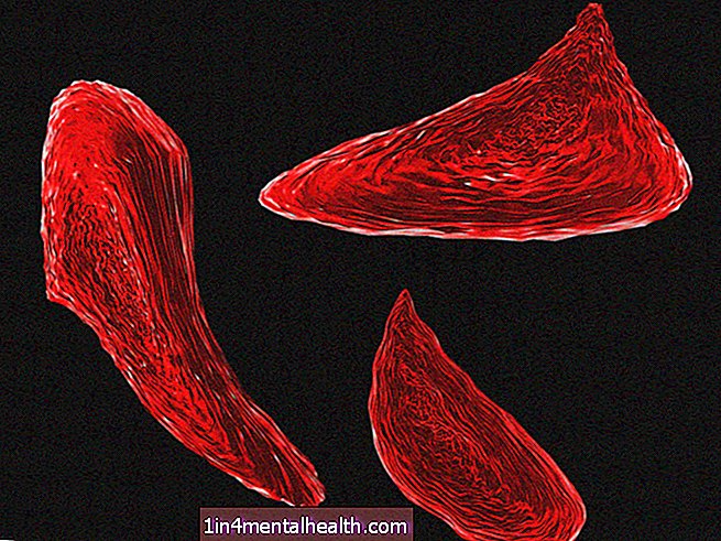 Qué saber sobre la anemia de células falciformes