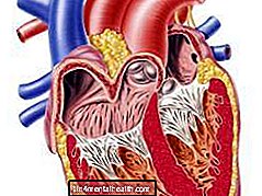 Kõik, mida peate teadma perikardiidi kohta - südamehaigus