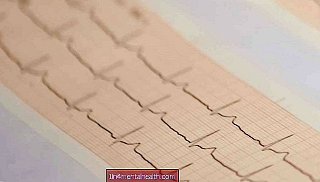 Mikä aiheuttaa epänormaalin EKG-tuloksen?