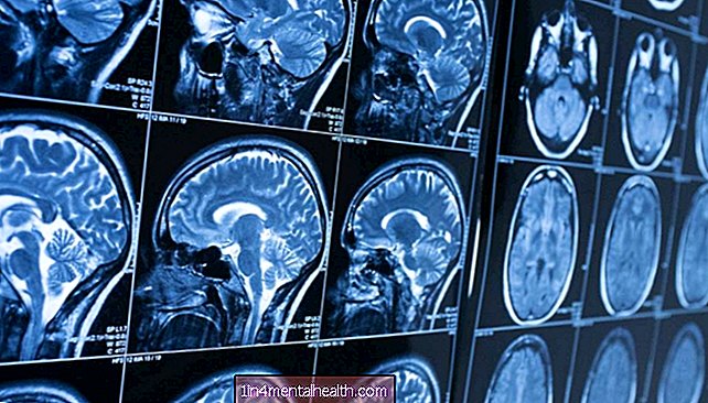 Naujas požiūris gali išgelbėti smegenų ląsteles sergant neurodegeneracinėmis ligomis - Huntingtono liga
