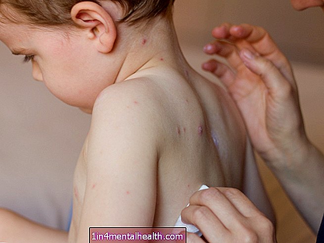 Kaj vedeti o ošpicah - imunski sistem - cepiva