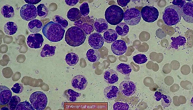 ¿Cuál es la diferencia entre leucemia y linfoma? - leucemia