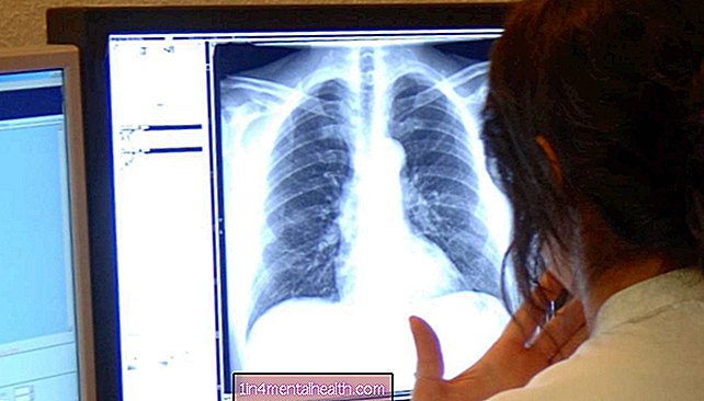 Ką reikia žinoti apie plaučių vėžį - plaučių vėžys