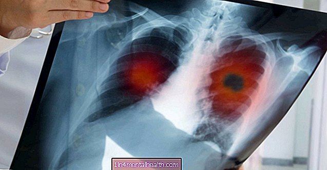 Защо ракът на белия дроб е толкова труден за лечение? - рак на белия дроб