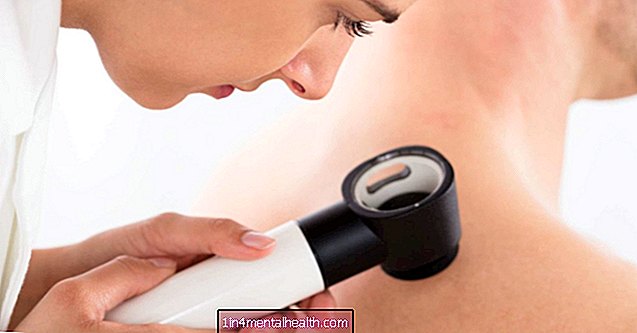 Gewichtsverlies vermindert het risico op huidkanker - melanoom - huidkanker