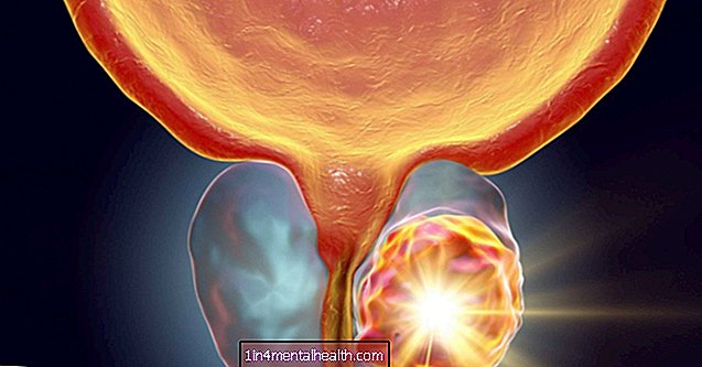 Co potřebujete vědět o pokročilém karcinomu prostaty - mužské zdraví