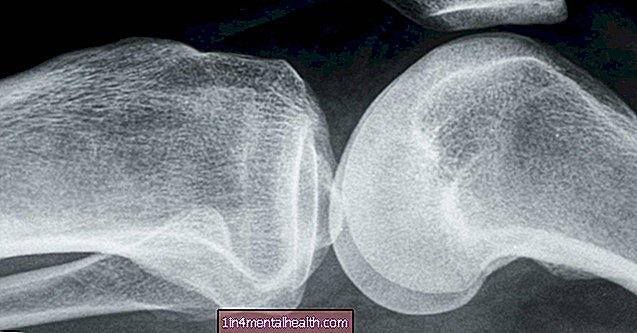 Osteoartritis: Ali lahko antioksidant nudi zaščito? - osteoartritis