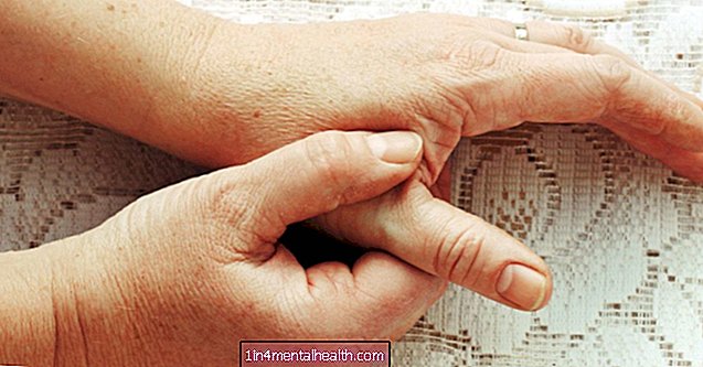 Artritída palca: Čo vedieť