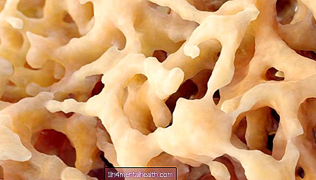 Osteoporoos suurendab dementsuse riski - osteoporoos