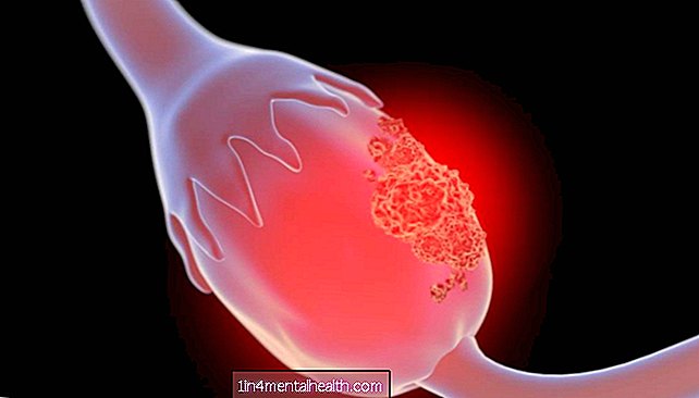 Rakovina vaječníků: Vědci najdou způsob, jak zahájit dvojí útok - rakovina vaječníků