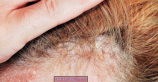 Шта могу учинити са псоријазом коже главе?