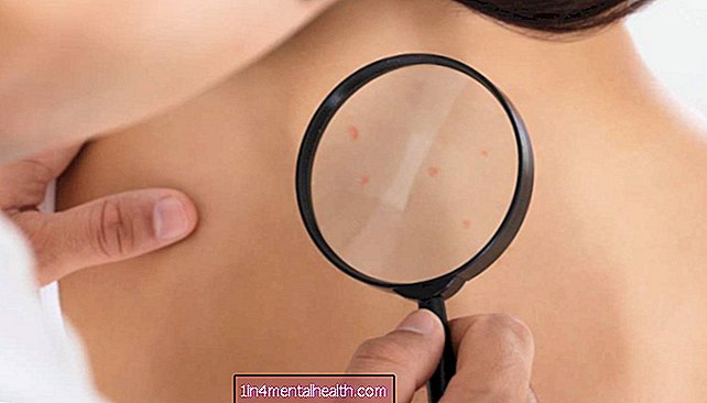 Kanker kulit: IBD umum, obat radang sendi dapat meningkatkan risiko
