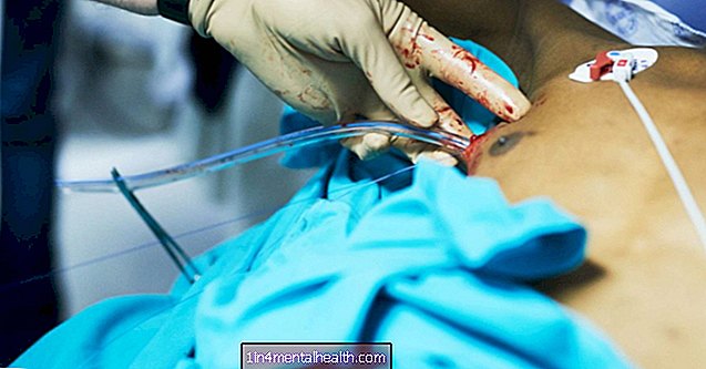 Umetanje prsne cijevi: Postupak, komplikacije i uklanjanje - plućni-sustav