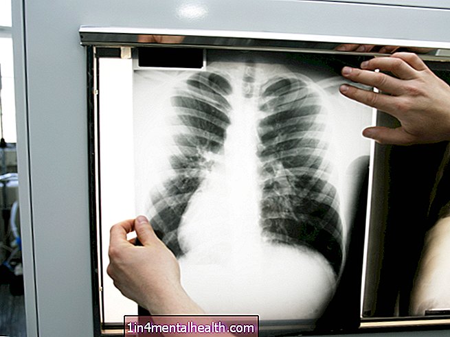 Ką reikia žinoti apie pleuritą - plaučių sistema