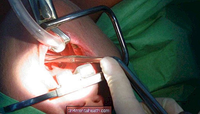 Tonzilektomija: procedūra un atveseļošanās - elpošanas