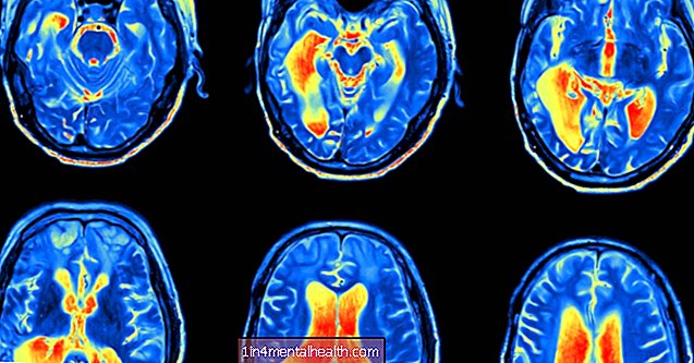 Artrita reumatoidă: modul în care inflamația cronică afectează creierul
