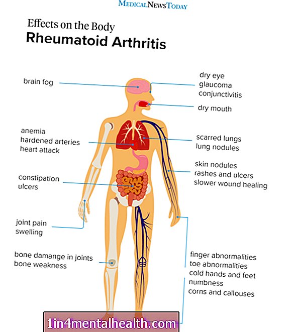 Kakšni so simptomi revmatoidnega artritisa? - revmatoidni artritis
