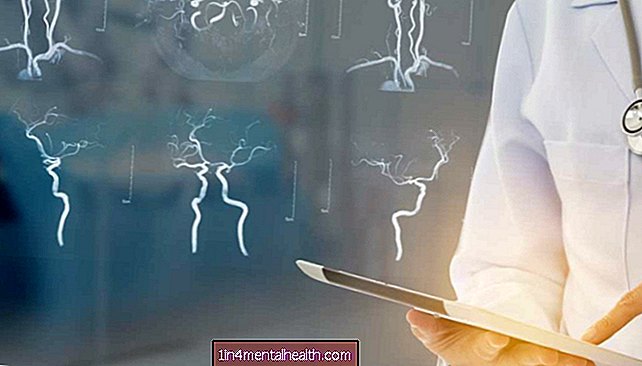 Accidentul vascular cerebral crește semnificativ riscul de demență