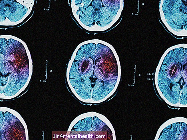 Co należy wiedzieć o udarze krwotocznym - udar mózgu
