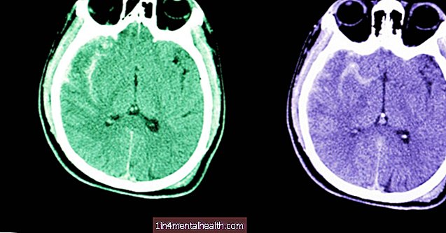 Kaj vedeti o subarahnoidni krvavitvi - možganska kap