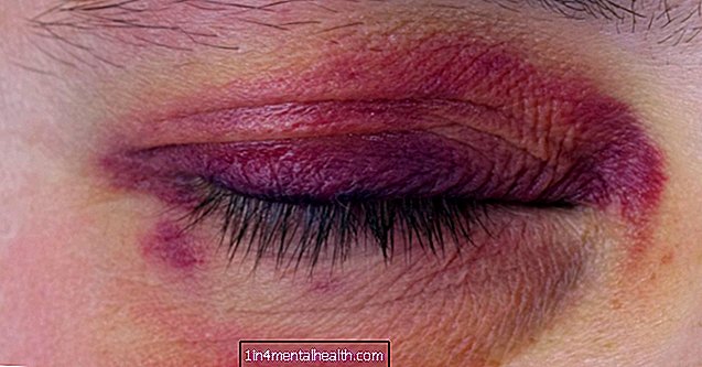 kirurgi - Ødelagt i knækkede øjne: Symptomer, kirurgi og bedring