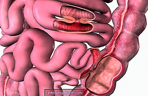 Čo je to gastrointestinálna fistula a čo ju spôsobuje? - chirurgický zákrok