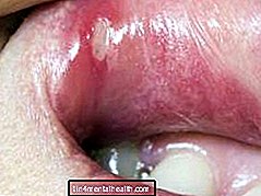 Vse, kar morate vedeti o razjedah v ustih - nekategorizirano